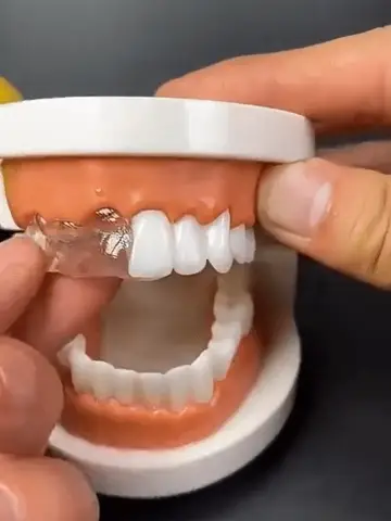 Teeth Gap Filler