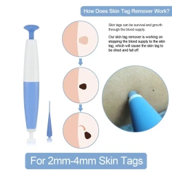 Skin Tag Removal Kit Home Use Mole Wart Remover