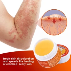 Dermatitis Eczemn Tinea Itching Silver Shavings And Antipruritic Skin care