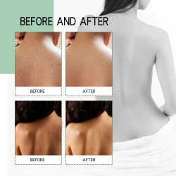 Back Acne Repair Back Shoulder Acne Desalination