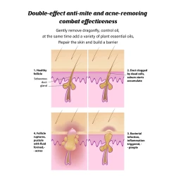 Acne Removing Mite Skin Soap Acne Inhibiting