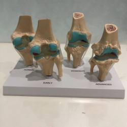 Four-Stage Diseased Knee Joint Model Sick Joint Model